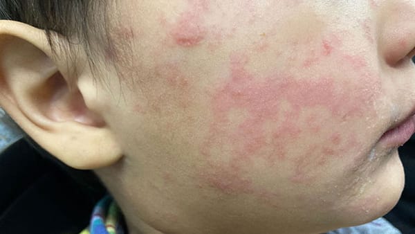 ICHD Gives Advice on Vaccinations, Exposure Guidelines After Ingham County Measles Case
